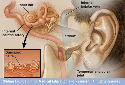 Tinnitus left untreated leads to hearing loss